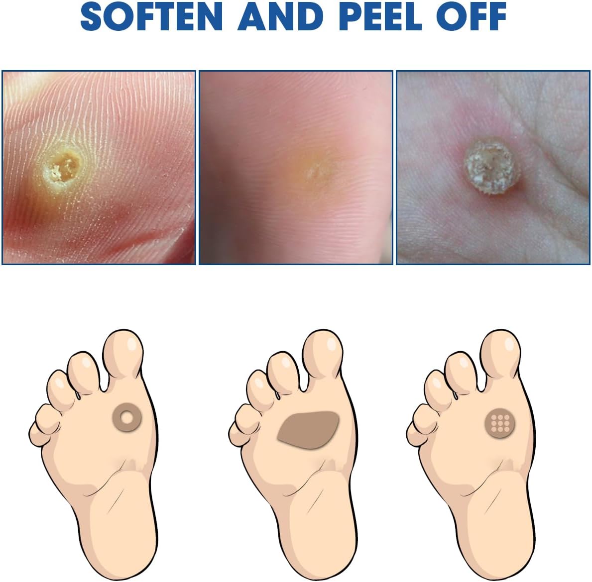Liquid Corn Remover, Corn Removers for Toes, Fast Acting, Safe Removes Corns Fast Extra Strength