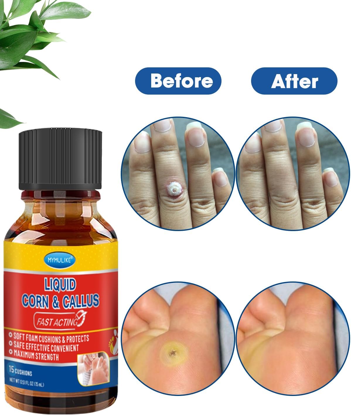 Liquid Corn Remover, Corn Removers for Toes, Fast Acting, Safe Removes Corns Fast Extra Strength