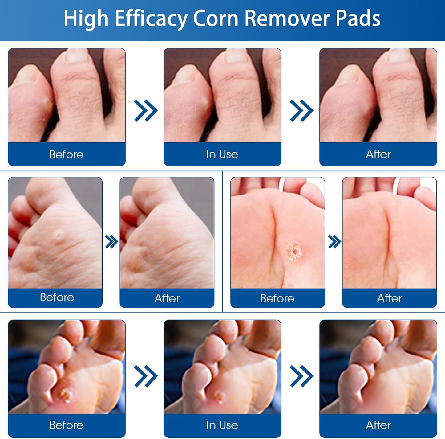 38 Count Corn Removal Pads for Feet and Toe, Corn Plasters Feet Remover for Feet Extra Strength