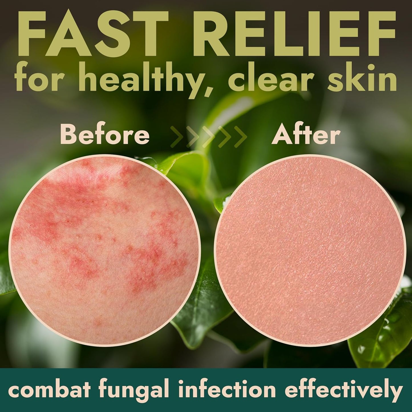 Body Spray with Tea Tree Oil | Fast-Absorbing Antifungal Treatment for Jock Itch, Athlete’s Foot
